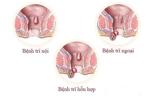 Bệnh trĩ hỗn hợp là gì? Cùng tìm hiểu cách điều trị dứt điểm