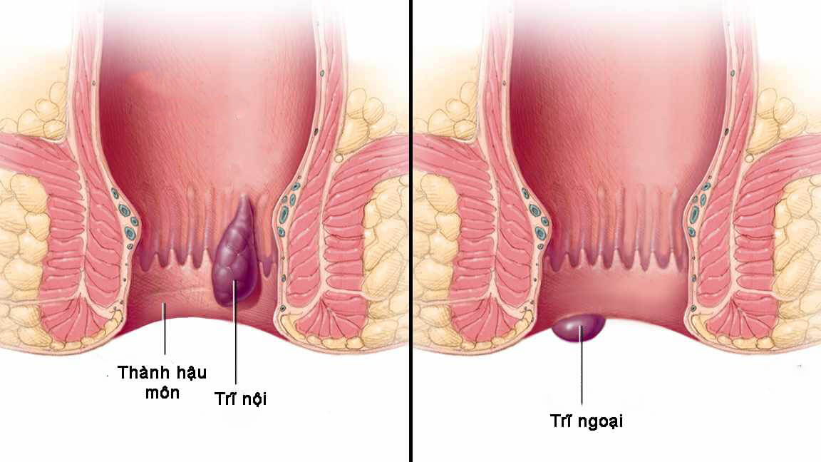 Bệnh Trĩ Nội Và Trĩ Ngoại? Phân Biệt Các Cấp Độ Của Bệnh Trĩ