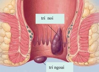 Bệnh trĩ nội - Chuyên mục bệnh trĩ