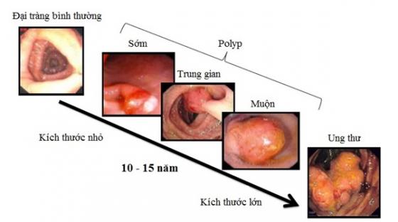 polyp-truc-trang.jpg