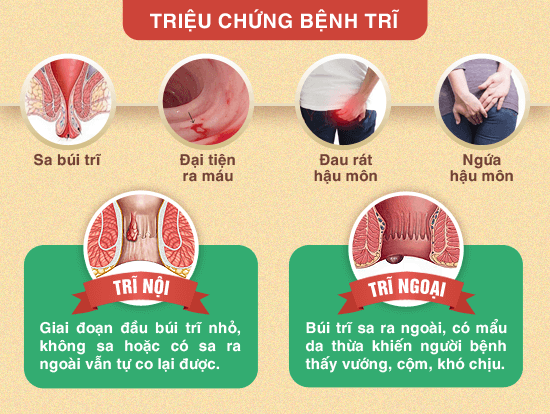 Phương Pháp trị liệu bệnh Trĩ Hiệu Quả